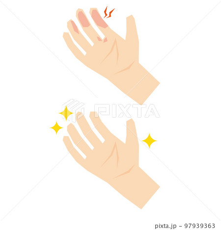 手指のアトピーのビフォーアフターイラスト素材 97939363