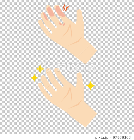 手指のアトピーのビフォーアフターイラスト素材 97939363