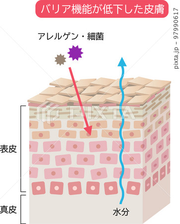 バリア機能が低い皮膚　肌細胞と断面図　立体 97990617