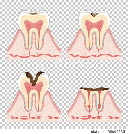 Tooth illustration_progression of tooth decay 98006386