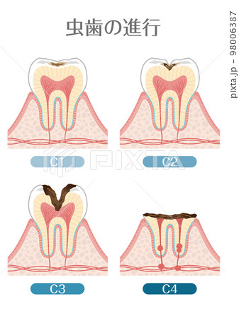 歯のイラスト_虫歯の進行 98006387