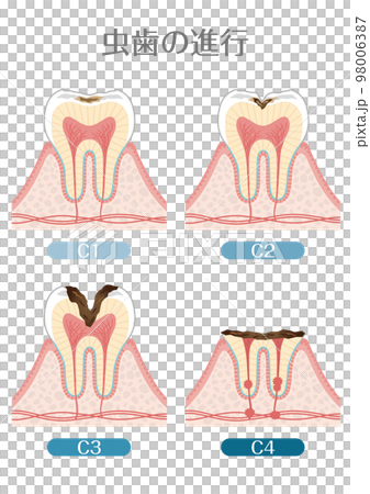 Tooth illustration_progression of tooth decay 98006387