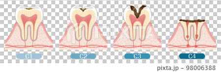 Tooth illustration_progression of tooth decay 98006388