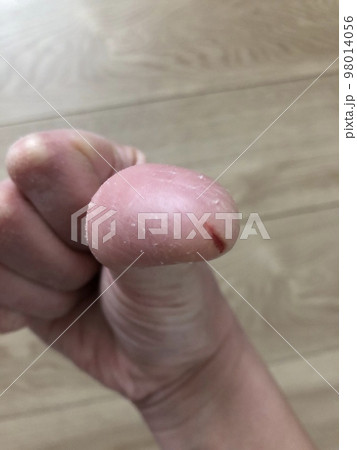右手親指にできた、アカギレの写真 98014056