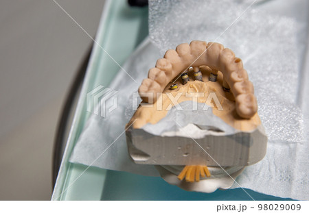 Plastic model of a permanent ceramic-metal dental prosthesis on implants 98029009