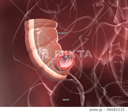 Appendicitis is a painful swelling of the appendix. Appendicitis is a painful swelling of the appendix. 98085235