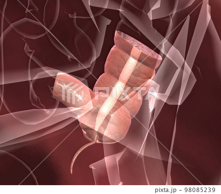 Appendicitis is a painful swelling of the appendix. 98085239