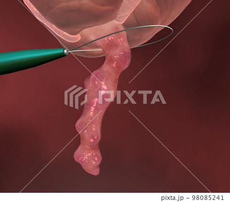 Appendicitis is a painful swelling of the appendix. 98085241