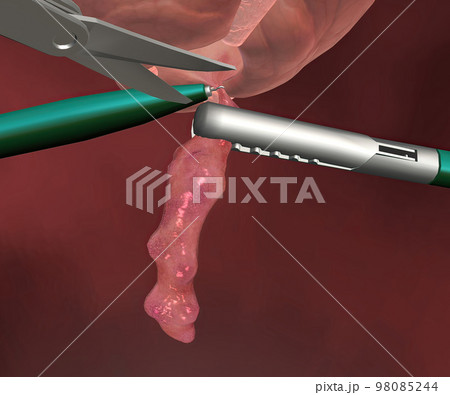 Appendicitis is a painful swelling of the appendix. 98085244