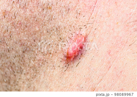 Keloid scar on neck of men 98089967