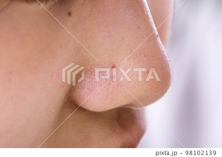 鼻のまわりを気にする10代の女の子 98102139