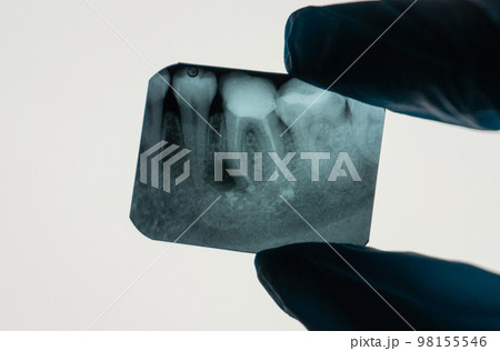 Dental Periapical Granuloma next to tooth root on an X-ray held by a Dentist 98155546