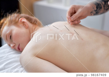 hand of professional doctor performing acupuncture therapy for redhead client. in clinic 98167409