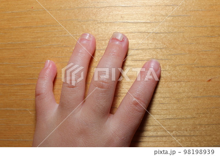 手足口病後の爪甲脱落症 98198939