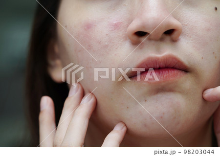 Acne pimple and scar on skin face, disorders of sebaceous glands, teenage girl skincare beauty problem. 98203044