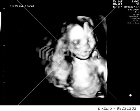 妊娠19週目の胎児のエコー写真の写真素材 [98221202] - PIXTA