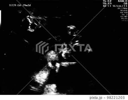 妊娠29週目の胎児のエコー写真 98221203