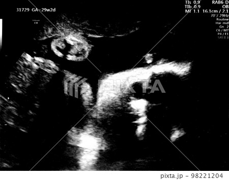 妊娠29週目の胎児のエコー写真 98221204