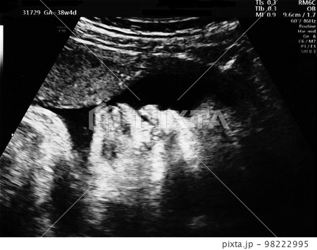 妊娠38週目の胎児のエコー写真 妊娠38週目の胎児のエコー写真 98222995