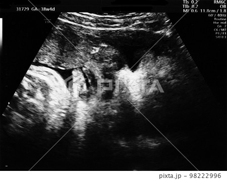 妊娠38週目の胎児のエコー写真 98222996