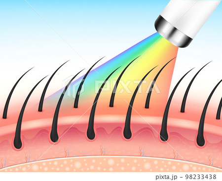 IPL light (Intense Pulsed Light) and Laser hair removal on skin layer leg. Unwanted out make skin smooth. Medical beauty science concept. About cosmetic technology. 3D Realistic vector EPS10. 98233438