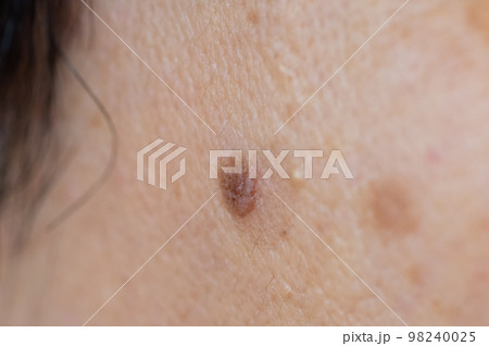 頬に脂漏性角化症ができている男性 98240025