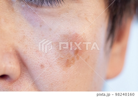 男性の頬にできた老人性色素斑 男性の頬にできた老人性色素斑 98240160