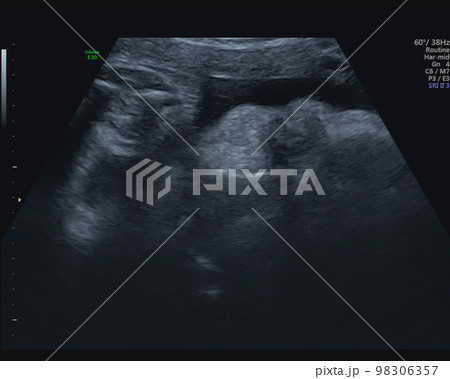 妊娠39週目の胎児のエコー写真 妊娠39週目の胎児のエコー写真 98306357