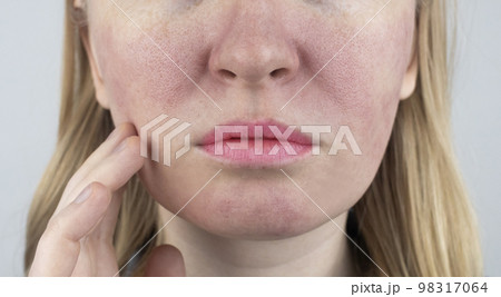 Enlarged pores. Close-up of skin with large pores. Dermatology and cosmetology. Treatment of problems associated with oily skin. Couperose and rosacea 98317064