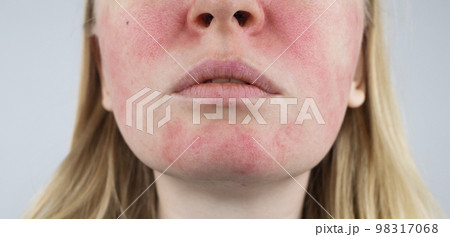 Rosacea face. The girl suffers from redness on her cheeks. Couperosis of the skin. Redness and capillary mesh are visible on the face. Treatment and removal. Vascular surgery and dermatology Rosacea face. The girl suffers from redness on her cheeks. Couperosis of the skin. Redness and capillary mesh are visible on the face. Treatment and removal. Vascular surgery and dermatology 98317068