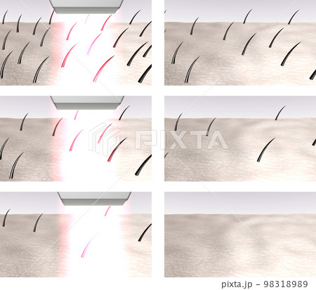 Laser hair removal step by step illustration 98318989