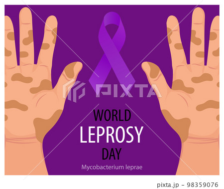 World Leprosy Day. Banner with sick hands and a purple ribbon, a symbol of the fight against leprosy. Medicine concept. Poster, vector	 98359076