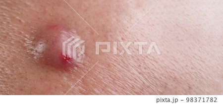 Bacterial skin infection. Big Acne Cyst Abscess or Ulcer Swollen area within face skin tissue. Containing accumulation of pus and blood. Macro shot of Acne or Dermatitis near mouth on face. Skincare. 98371782