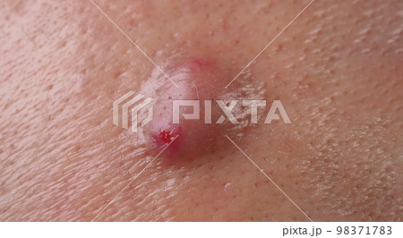 Bacterial skin infection. Big Acne Cyst Abscess or Ulcer Swollen area within face skin tissue. Containing accumulation of pus and blood. Macro shot of Acne or Dermatitis near mouth on face. Skincare. 98371783