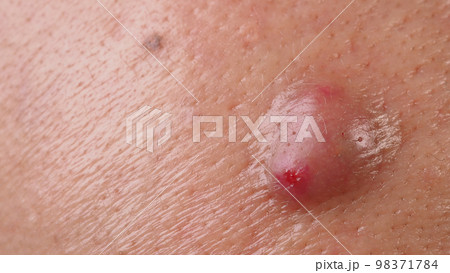 Bacterial skin infection. Big Acne Cyst Abscess or Ulcer Swollen area within face skin tissue. Containing accumulation of pus and blood. Macro shot of Acne or Dermatitis near mouth on face. Skincare. Bacterial skin infection. Big Acne Cyst Abscess or Ulcer Swollen area within face skin tissue. Containing accumulation of pus and blood. Macro shot of Acne or Dermatitis near mouth on face. Skincare. 98371784