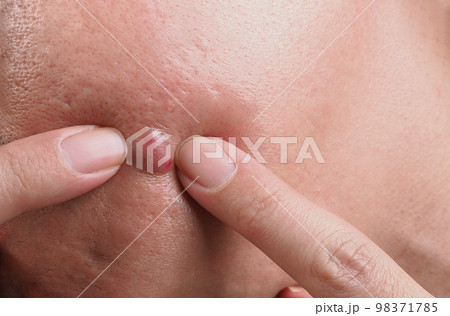 Bacterial skin infection. Big Acne Cyst Abscess or Ulcer Swollen area within face skin tissue. Containing accumulation of pus and blood. Macro shot of Acne or Dermatitis near mouth on face. Skincare. Bacterial skin infection. Big Acne Cyst Abscess or Ulcer Swollen area within face skin tissue. Containing accumulation of pus and blood. Macro shot of Acne or Dermatitis near mouth on face. Skincare. 98371785