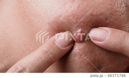 Bacterial skin infection. Big Acne Cyst Abscess or Ulcer Swollen area within face skin tissue. Containing accumulation of pus and blood. Macro shot of Acne or Dermatitis near mouth on face. Skincare. 98371786
