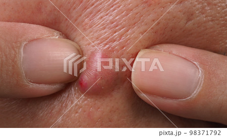 Bacterial skin infection. Big Acne Cyst Abscess or Ulcer Swollen area within face skin tissue. Containing accumulation of pus and blood. Macro shot of Acne or Dermatitis near mouth on face. Skincare. Bacterial skin infection. Big Acne Cyst Abscess or Ulcer Swollen area within face skin tissue. Containing accumulation of pus and blood. Macro shot of Acne or Dermatitis near mouth on face. Skincare. 98371792