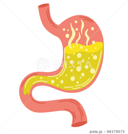 Human stomach. Gastritis and acid reflux, indigestion, vomiting, heartburn and stomach pain problems. Unhealthy stomach concept. Heartburn, illness, discomfort, pain. Flat vector illustration 98379073
