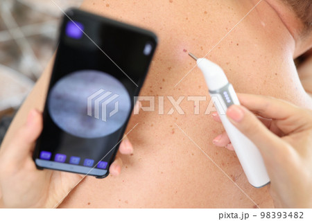 Dermatologist removes pigmentation on skin of patient close up. 98393482