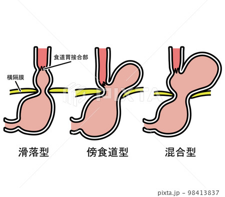 食道裂孔ヘルニア 98413837