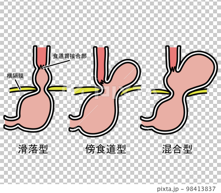 食道裂孔ヘルニア 98413837