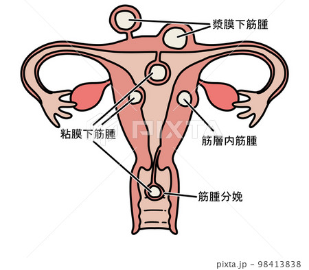 子宮筋腫 98413838