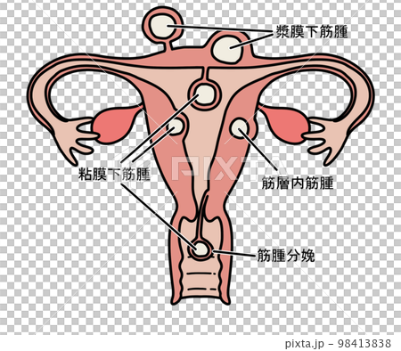 子宮筋腫 98413838