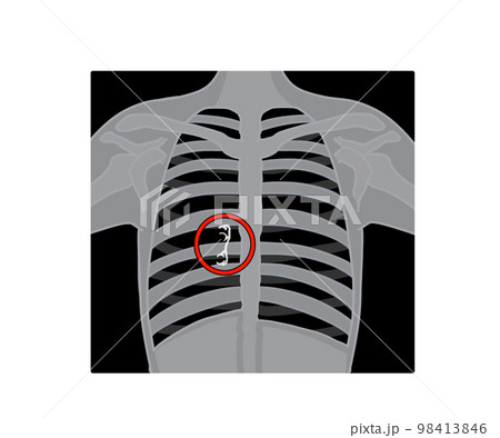 異物誤飲 異物誤飲 98413846