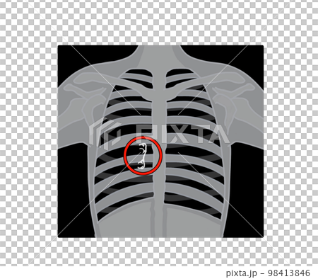 異物誤飲 異物誤飲 98413846