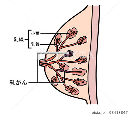 乳がん 乳がん 98413847
