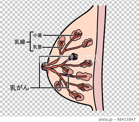 乳がん 乳がん 98413847