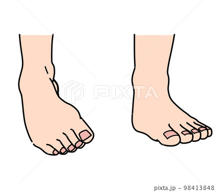 内反尖足 98413848