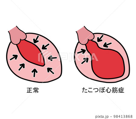 たこつぼ型心筋症 98413868